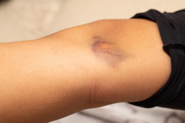 Close up of wound with dried blood on injured knee
