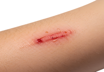 Closeup of a Linear Laceration on Fair Skin isolated on transparent baackground