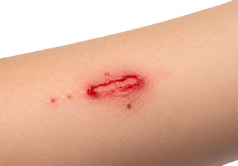 Fototapeta premium Closeup of a Laceration on Fair Skin isolated on transparent baackground
