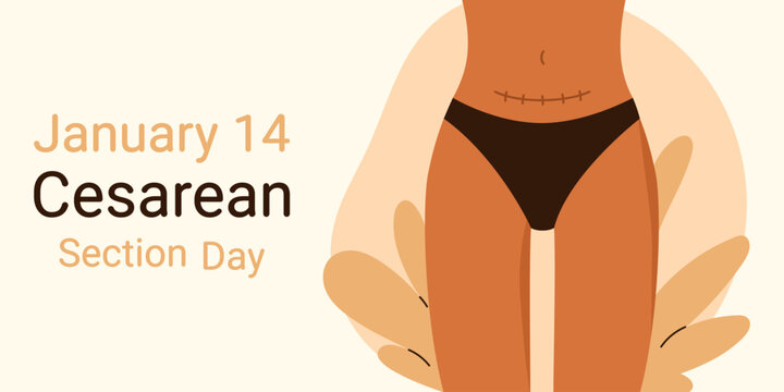 January 14. Cesarean Section Day. Cesarean scar. Stitches after caesarean section on female belly. C-section, surgical delivery operation concept. Isolated vector illustration in cartoon style

