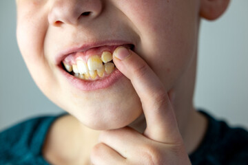 close-up hand of child, boy 10 years old points new tooth fang in mouth with finger, children's...