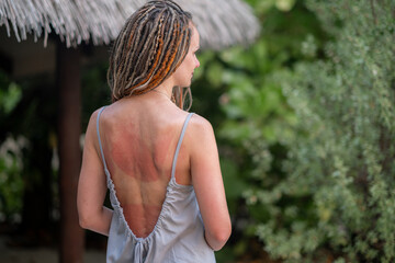 Back of a woman with visible sunburn lines and tan marks from swimsuit, standing outdoors in strappy summer dress, skin damage after beach vacation, sun care, travel and skincare