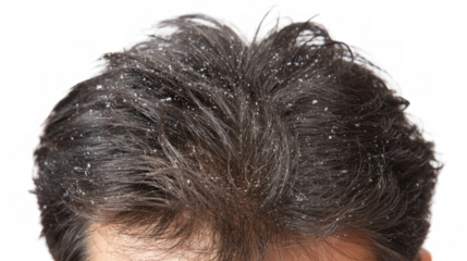 Dandruff flakes are clearly visible on a person's dark hair, indicating a scalp condition, against a transparent background, ideal for health and hygiene related projects