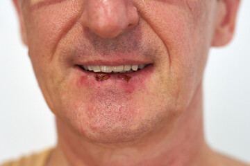 Close-up of man's face and lips affected by herpes simplex infection, showing inflammation