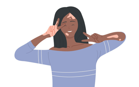 Girl with skin problems vitiligo vector illustration. Cartoon young happy woman character with depigmentation patches smiling, beautiful body positive model waving. International vitiligo day concept