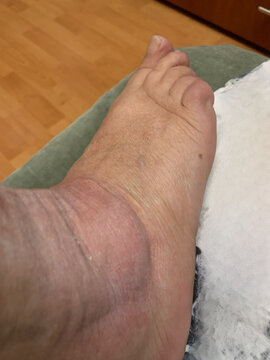 Swollen feet, reaction to insect bite, swelling of feet can occur for physiological reasons such as heat, prolonged standing, heart, kidney and vascular disease, injuries, infections&nbsp;