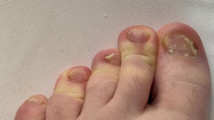 Onychomycosis. A dangerous fungal infection of human toenails. Disease and detachment of the nail plate. Difficult treatment. Routine check-up with an infectious disease specialist. Top view on a whit