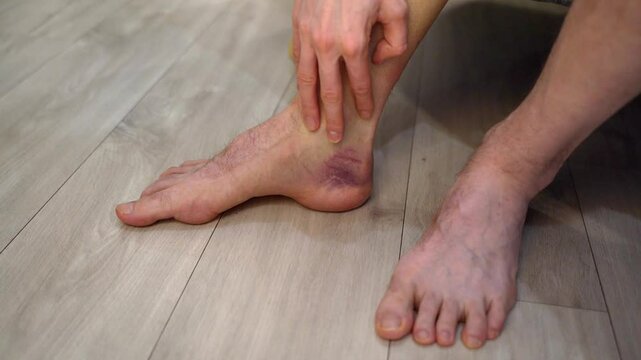 Man leg with visible ankle bruising and swelling, shifting weight slightly to one foot. Concept of mobility testing after injury and observing recovery response in lower limb with bruise discomfort