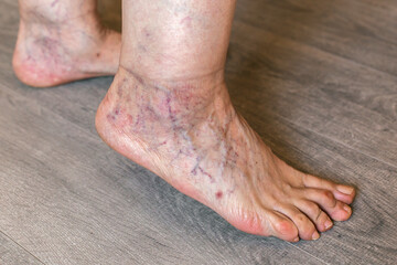 Close-up of elderly feet with varicose veins and bunion wearing toe corrector, standing on wooden...