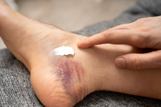 Hand gently massaging, apply repair cream over visible ankle bruise. Concept of soothing balm for healing injured foot, natural treatment for hematoma using ingredients like Arnica and horse chestnut