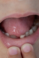 A close-up of a child's mouth with a wobbly baby tooth. 

