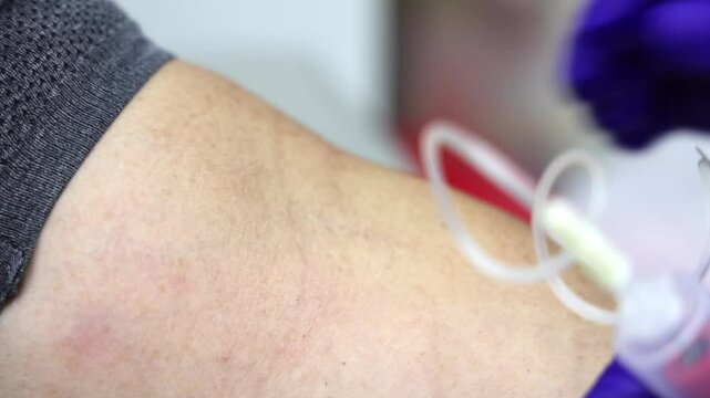Nurse inserts a butterfly needle into a donor's arm during a blood draw or blood donation procedure