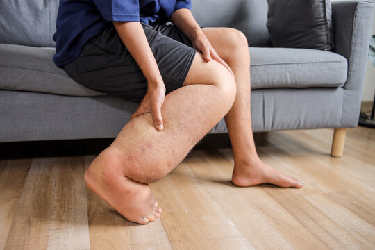 Close Up Of Severely Swollen Lower Leg And Foot, Indicating Medical Condition