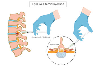 Epidural steroid injection is a medical procedure where corticosteroids.