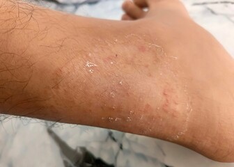 Closeup of Tinea Infection on Foot