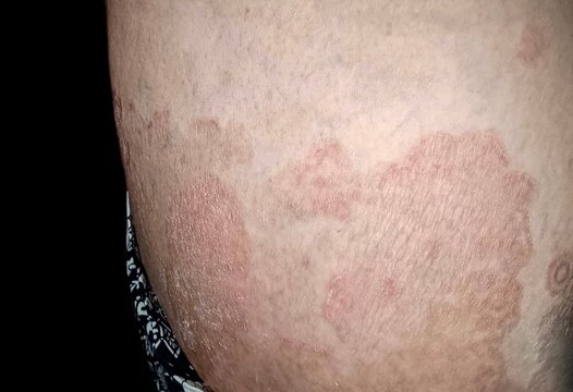 Tinea Cruris Rash on Skin Surface of Thigh