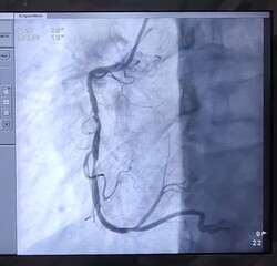 Coronary angiogram of right coronary artery during cardiac catheterization with dye. Findings...
