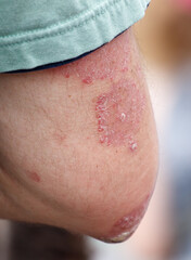 Fototapeta premium A person's leg has a rash on it