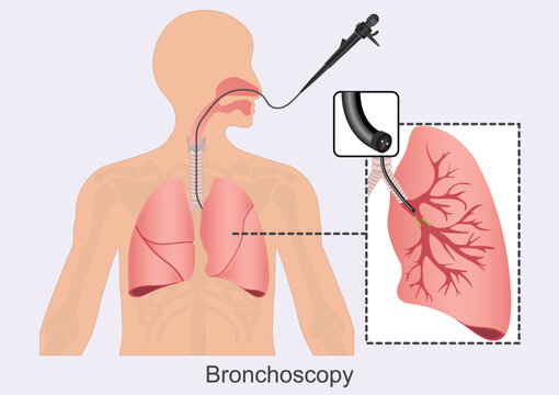 Bronchoscopy is a procedure that lets doctors look at lungs and air passages.