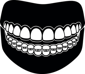 Human mouth with teeth and braces silhouette vector illustration