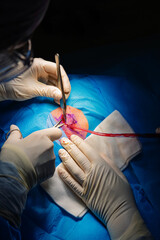 Dermatologic surgery in the operating room. Cutting the lesion and aspirating the fluids.