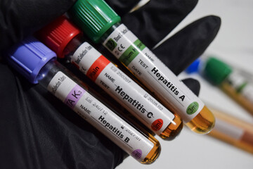 Hepatitis A, B, C - Test with blood sample. Top view isolated on office desk. Healthcare or Medical...
