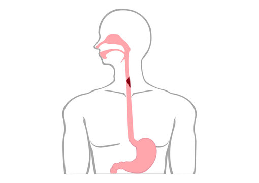 食道がんの人体内部