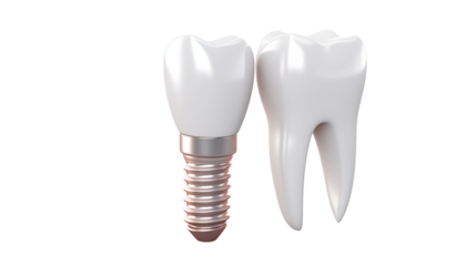 Dental Implant Crown Restoration Perfect White Tooth Implant Dentistry