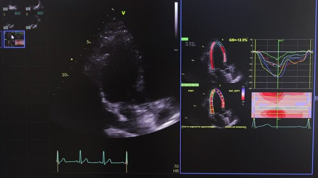 Cardiac Ultrasound Display with ECG, Medical Imaging and Heart Strain Analysis