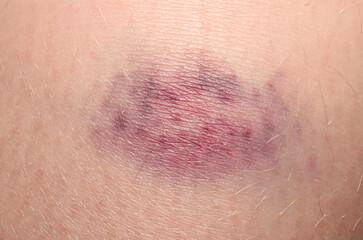 Injury bruise on child skin closeup purple healing medical concept