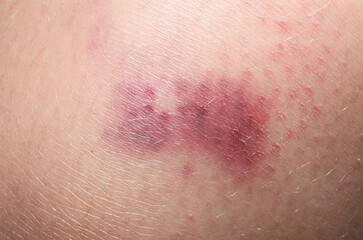 Child skin bruise injury closeup purple mark healing process