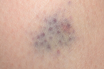 Purple bruise on baby skin close injury mark natural healing