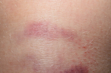 Bruise on child skin closeup injury purple discoloration medical