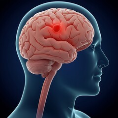  A human brain with a blood clot obstructing blood flow, symbolizing ischemic stroke.