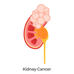 Kidney cancer bladder tumor anatomy drawing illustration