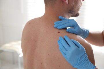 Doctor examining man's moles in hospital, closeup