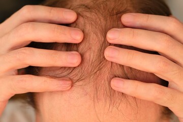 Man showing hair loss on his head.
