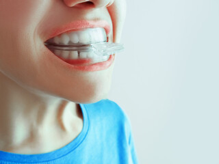 Caucasian young woman with dental caps in mouth, open mouth close-up. White background.