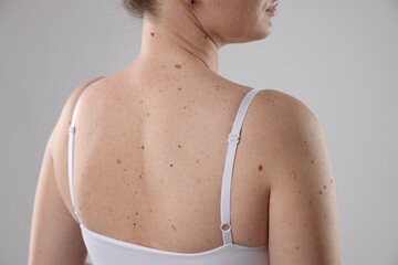 Woman with moles on her body against light background, closeup
