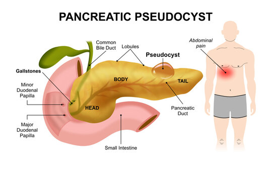Pancreatic Pseudocyst, fluid filled sac in pancreas illustration