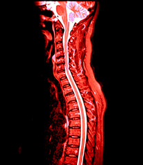 The MRI scan of the cervical spine shows detailed imaging of the vertebrae and spinal cord, highlighted in vibrant pink. The clear delineation of the spinal cord and vertebral structures is evident.