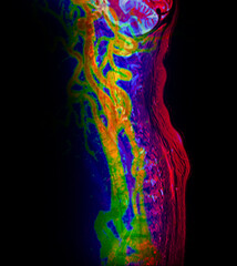 The MRI scan of the cervical spine shows detailed imaging of the vertebrae and spinal cord, highlighted in vibrant pink. The clear delineation of the spinal cord and vertebral structures is evident.