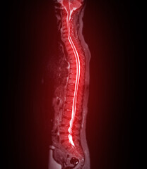 MRI whole spine screening for diagnosis spinal cord compression.