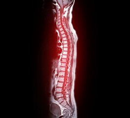 MRI whole spine screening for diagnosis spinal cord compression.