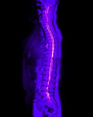 MRI whole spine screening for diagnosis spinal cord compression.