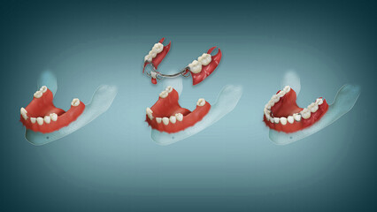 3D image of Partial denture for lower jaw. Before-after illustration.