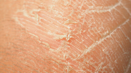 Close up of heel foot peeling skin