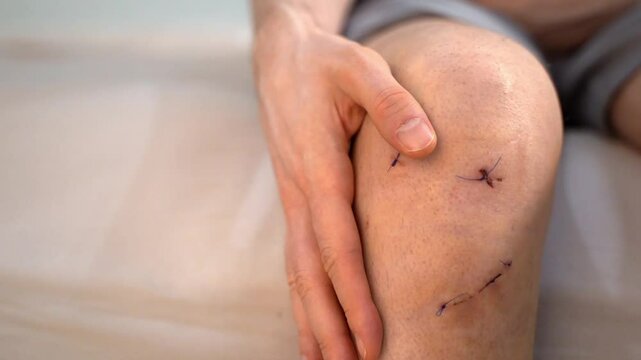 Male hand gently touches his knee wound with healing stitches after anterior cruciate ligament surgery. Concept of postoperative monitoring, injury management and personal care at home. Copy space