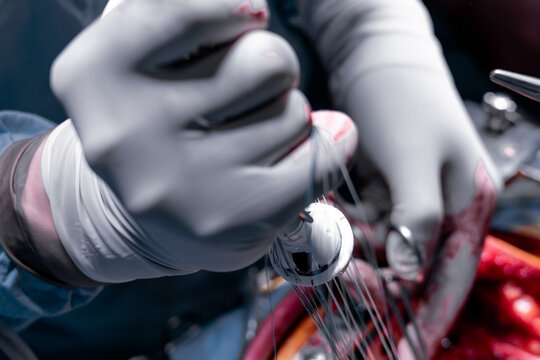Close up view of implantation of a prosthetic valve (mechanical heart valve) at aortic valve. Hand in gloves hold the holder for valve prosthesis, in sterile operating room. High quality photo