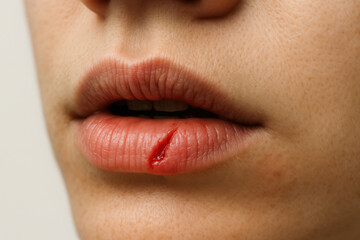 close-up of woman's lips with visible crack, highlighting dry skin and winter skincare needs. perfect image for articles on self-care, dermatology, and hydration tips.